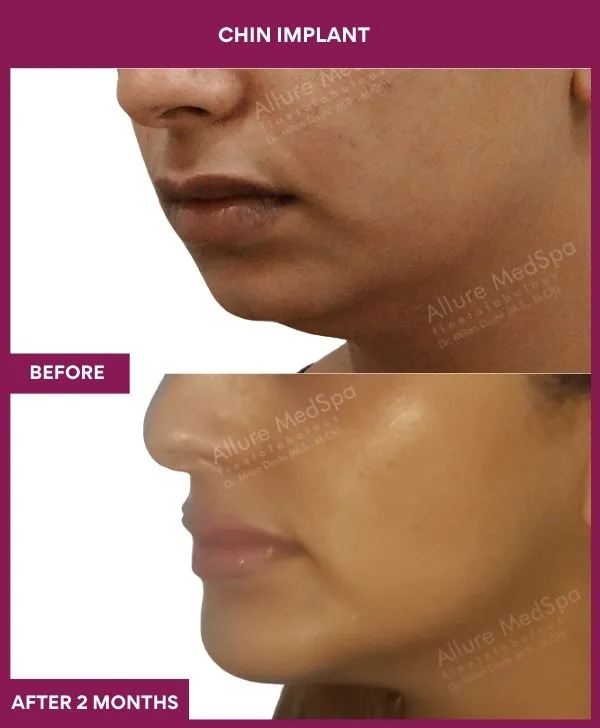Chin Augmentation Before & After: How to Read Results (Realistic Expectations) 39 14 Chin Implant (5)_39_