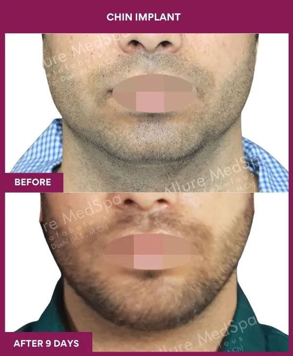 Chin Augmentation Before & After: How to Read Results (Realistic Expectations) 41 15 Chin Implant_43_ (1)