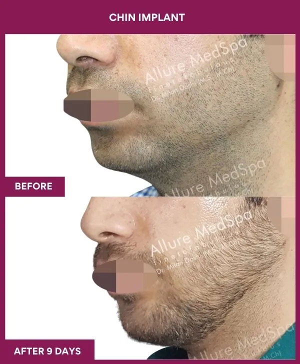 Chin Augmentation Before & After: How to Read Results (Realistic Expectations) 42 15 Chin Implant_43_ (2)