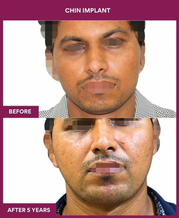 Chin Augmentation Before & After: How to Read Results (Realistic Expectations) 44 16 Chin Implant (1)