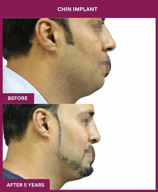 Chin Augmentation Before & After: How to Read Results (Realistic Expectations) 46 17 Chin Implant (3)