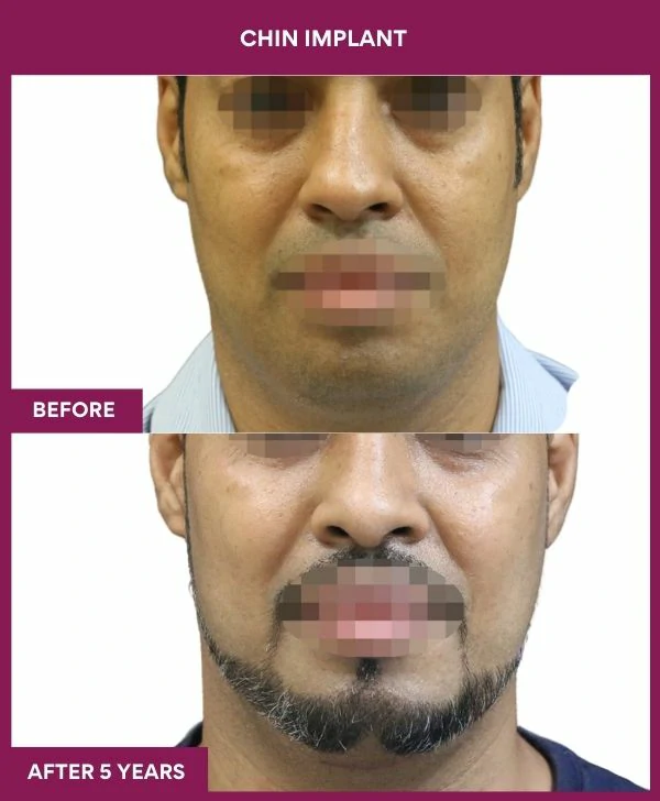 Chin Augmentation Before & After: How to Read Results (Realistic Expectations) 47 17 Chin Implant (4)