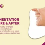 CHIN AUGMENTATION BEFORE & AFTER