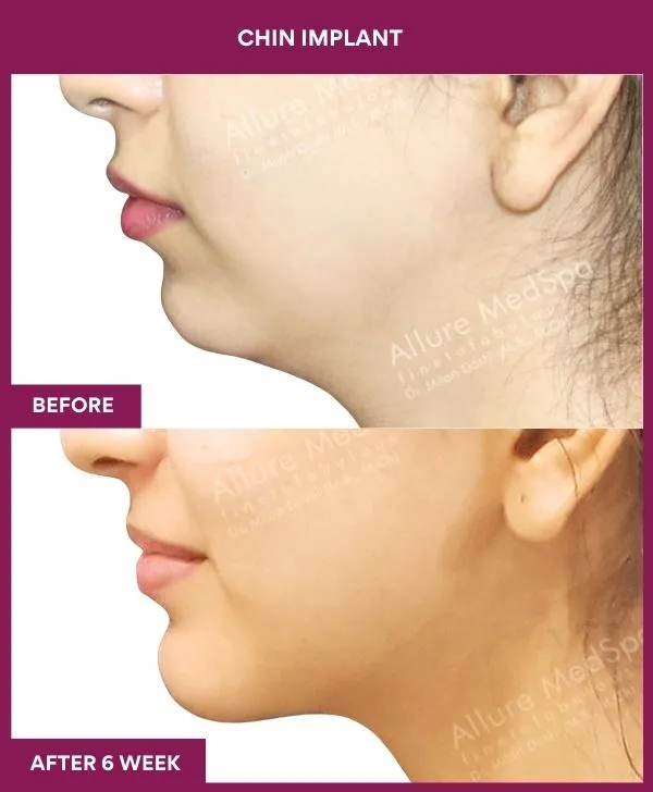 Chin Augmentation Before & After: How to Read Results (Realistic Expectations) 3 2 Chin Implant (3)_4_