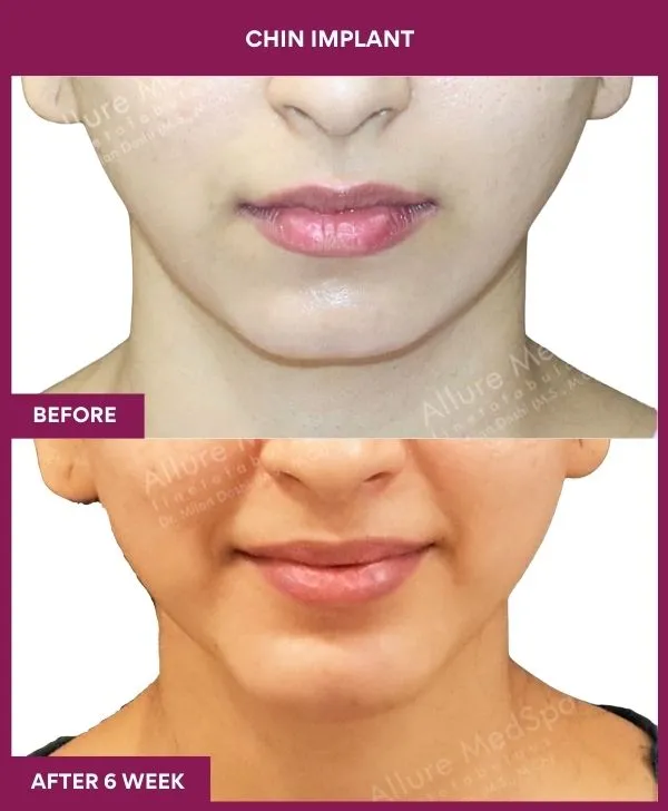 Chin Augmentation Before & After: How to Read Results (Realistic Expectations) 2 2 Chin Implant (4)_4_