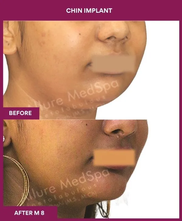 Chin Augmentation Before & After: How to Read Results (Realistic Expectations) 7 3 Chin Implant (2)_7_