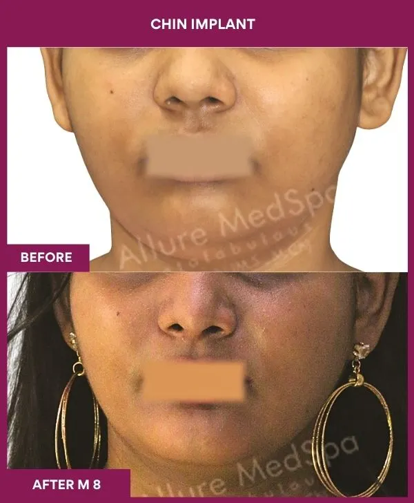 Chin Augmentation Before & After: How to Read Results (Realistic Expectations) 8 3 Chin Implant (4)_7_