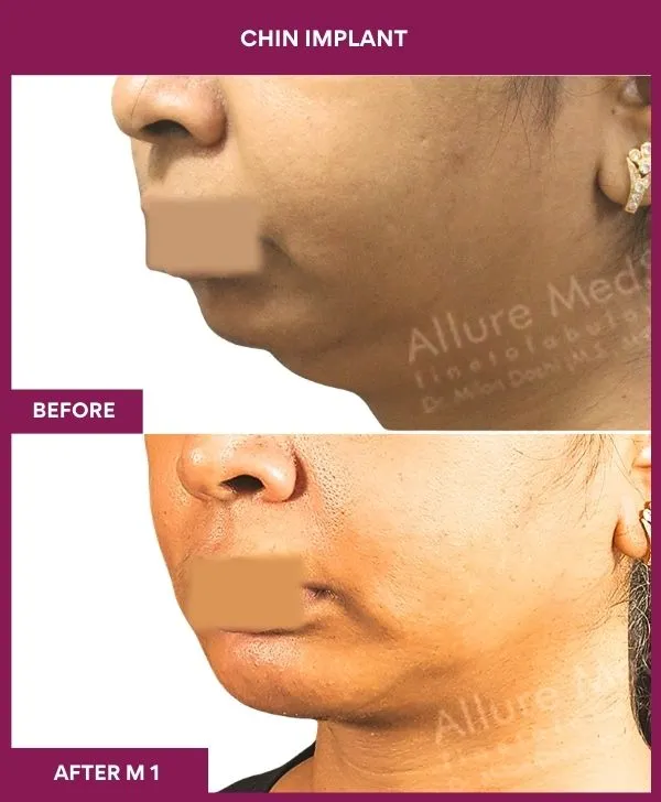 Chin Augmentation Before & After: How to Read Results (Realistic Expectations) 12 4 Chin Implant (3)_10_