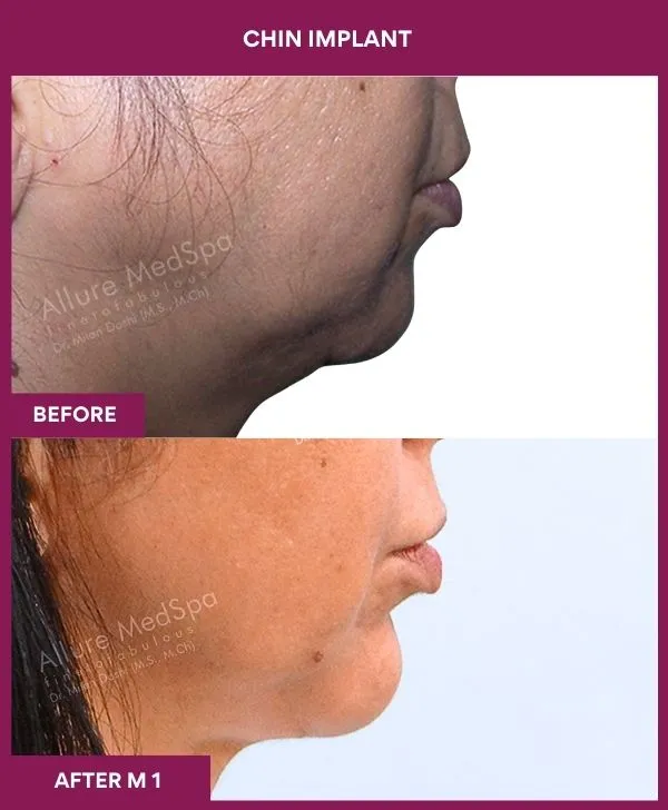 Chin Augmentation Before & After: How to Read Results (Realistic Expectations) 13 5 Chin Implant (2)_13_