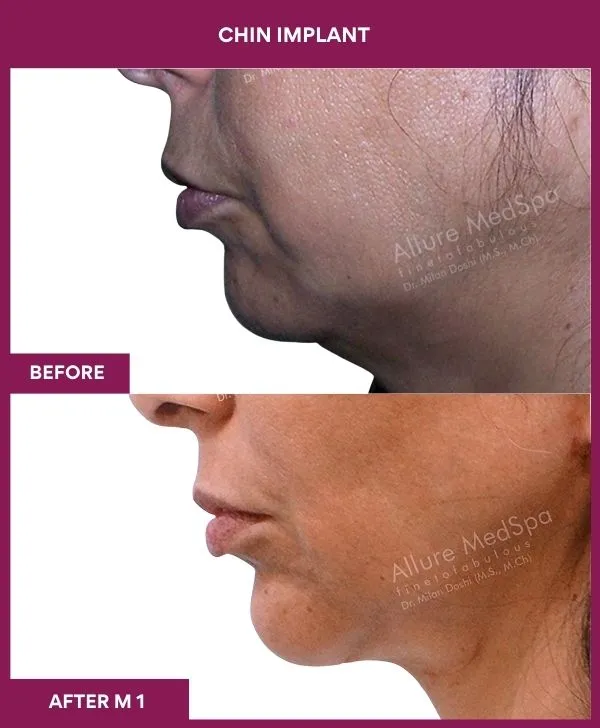 Chin Augmentation Before & After: How to Read Results (Realistic Expectations) 15 5 Chin Implant (3)_13_