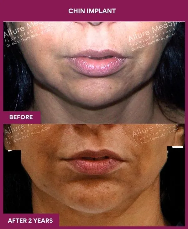 Chin Augmentation Before & After: How to Read Results (Realistic Expectations) 14 5 Chin Implant (4)_13_
