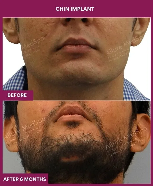 Chin Augmentation Before & After: How to Read Results (Realistic Expectations) 17 6 Chin Implant (4)_17