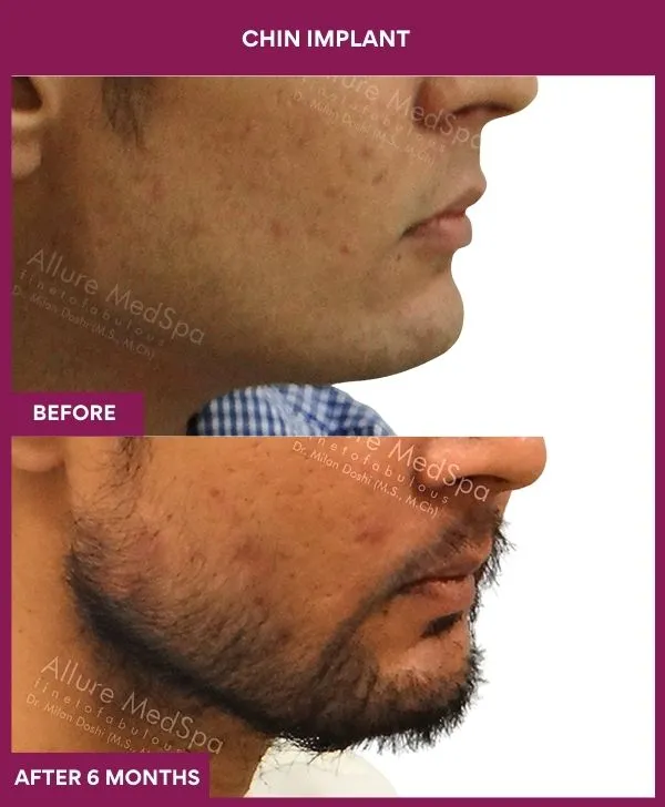Chin Augmentation Before & After: How to Read Results (Realistic Expectations) 16 6 Chin Implant (5)_17