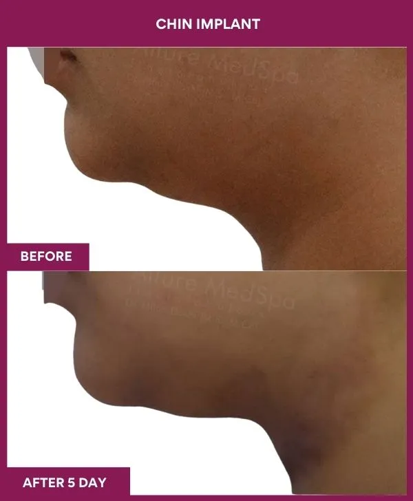 Chin Augmentation Before & After: How to Read Results (Realistic Expectations) 21 7 Chin Implant ) (3)_16_