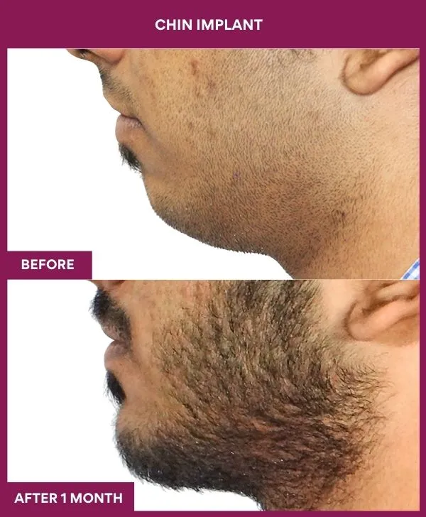 Chin Augmentation Before & After: How to Read Results (Realistic Expectations) 6 7 Chin Implant (3)_20_