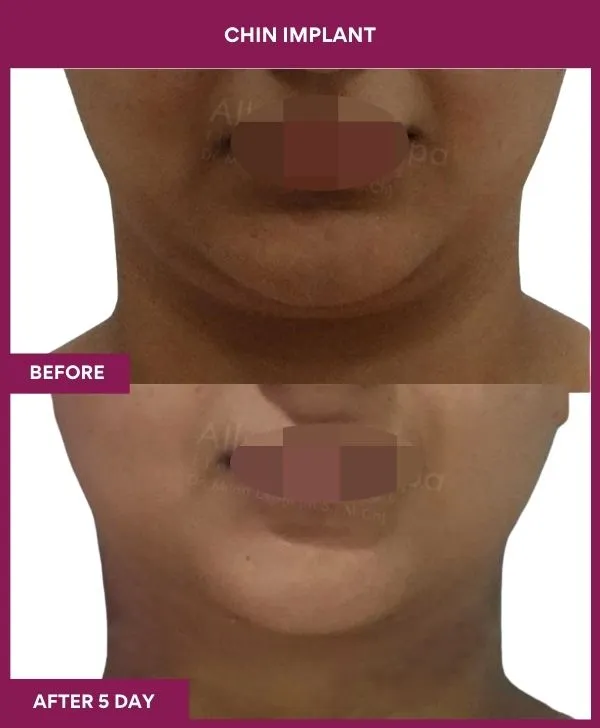 Chin Augmentation Before & After: How to Read Results (Realistic Expectations) 20 7 Chin Implant ) (4)_16_