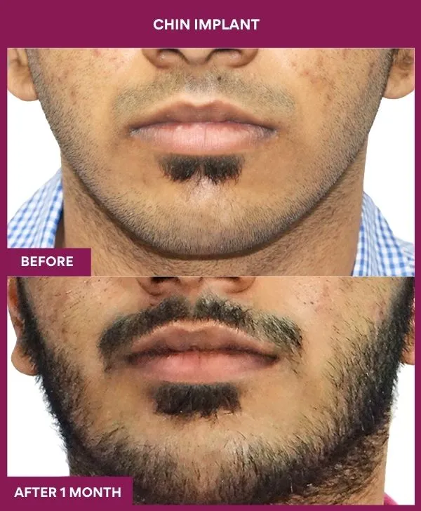 Chin Augmentation Before & After: How to Read Results (Realistic Expectations) 5 7 Chin Implant (4)_20_