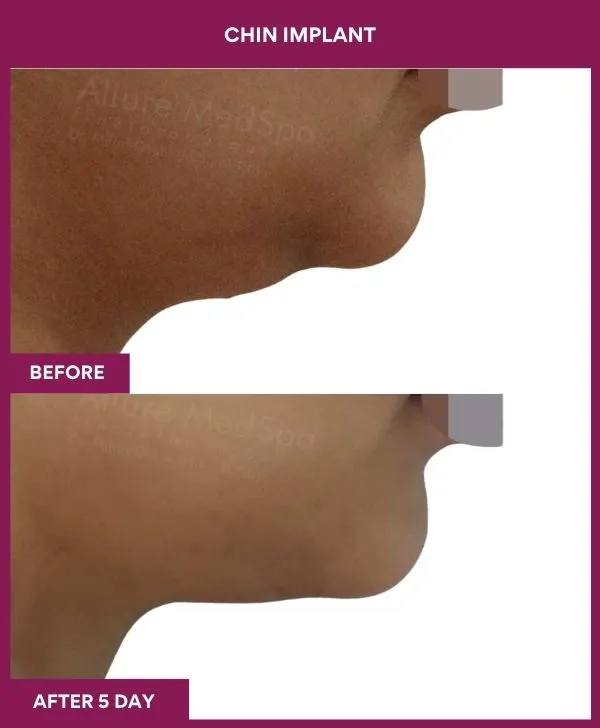 Chin Augmentation Before & After: How to Read Results (Realistic Expectations) 19 7 Chin Implant ) (5)_16_