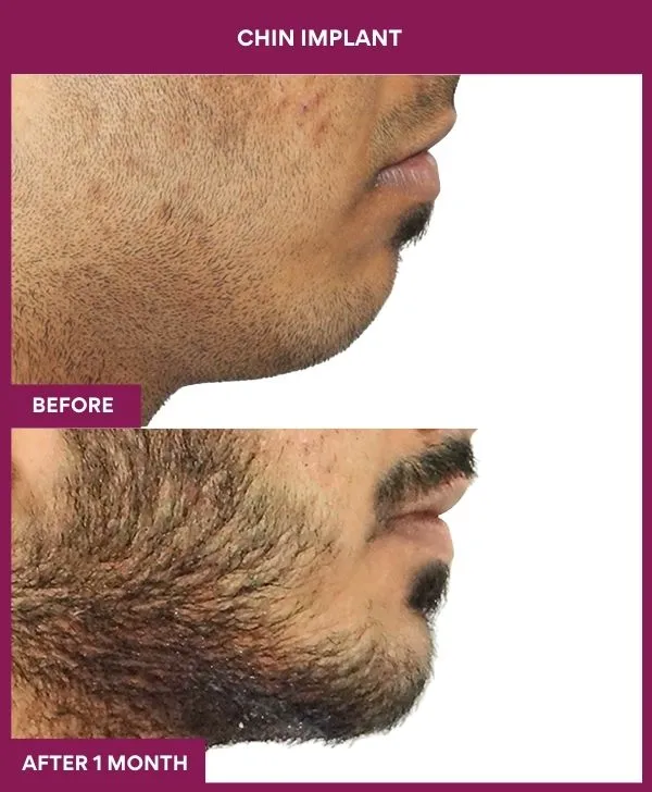 Chin Augmentation Before & After: How to Read Results (Realistic Expectations) 4 7 Chin Implant (5)_20_