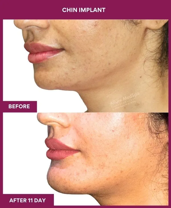 Chin Augmentation Before & After: How to Read Results (Realistic Expectations) 27 8 Chin Implant (3)_23_