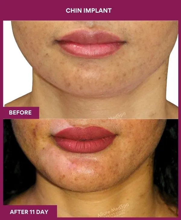 Chin Augmentation Before & After: How to Read Results (Realistic Expectations) 26 8 Chin Implant (4)_23_