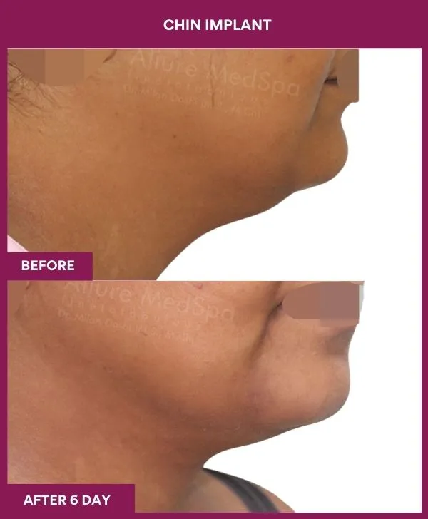 Chin Augmentation Before & After: How to Read Results (Realistic Expectations) 22 8 Chin Implant ) (5)_19_