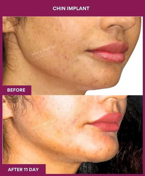 Chin Augmentation Before & After: How to Read Results (Realistic Expectations) 25 8 Chin Implant (5)_23_