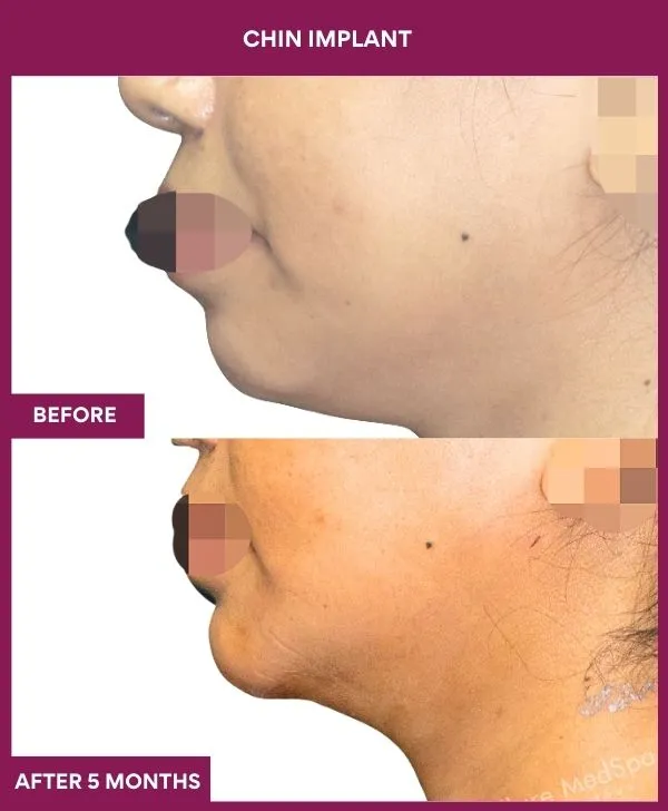 Chin Augmentation Before & After: How to Read Results (Realistic Expectations) 30 9 Chin Implant (3)_26_