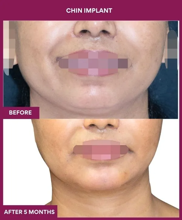 Chin Augmentation Before & After: How to Read Results (Realistic Expectations) 29 9 Chin Implant (4)_26_