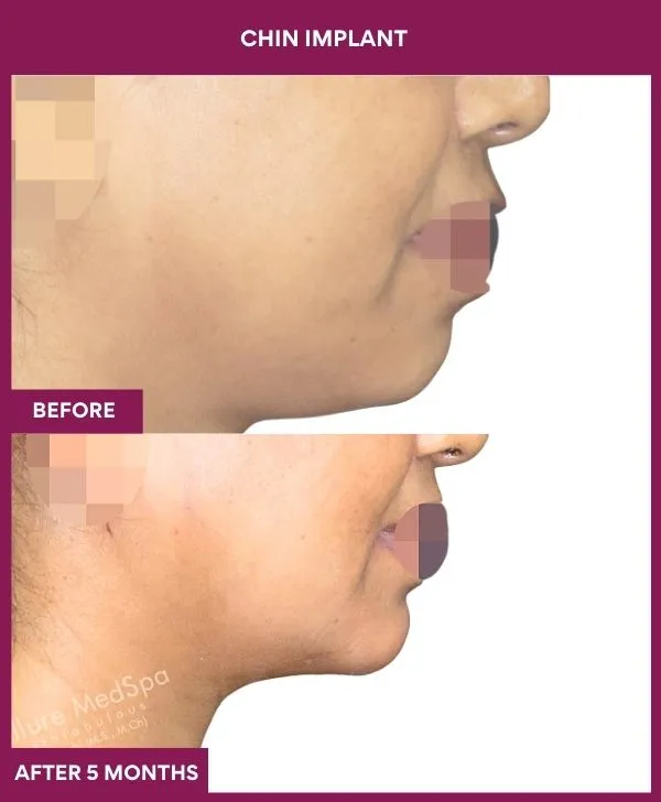 Chin Augmentation Before & After: How to Read Results (Realistic Expectations) 28 9 Chin Implant (5)_26_