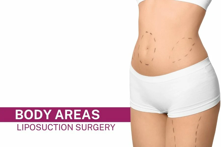 Liposuction Surgery Body Areas Featured Image