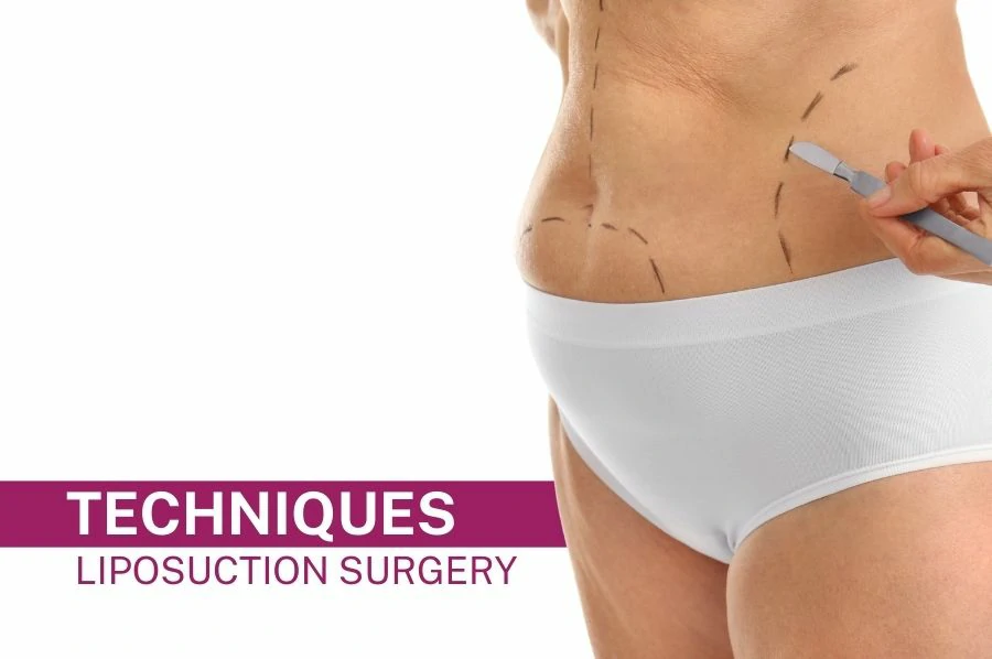 Liposuction Surgery Techniques