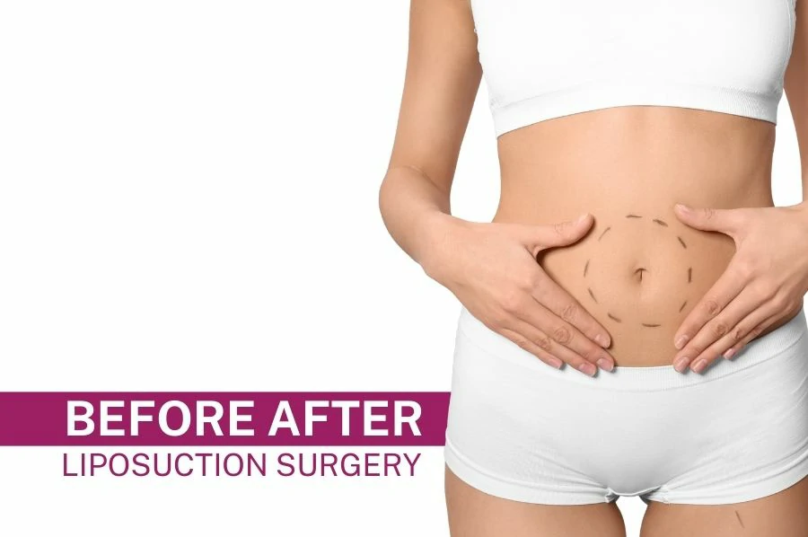 Liposuction Surgery before after Images